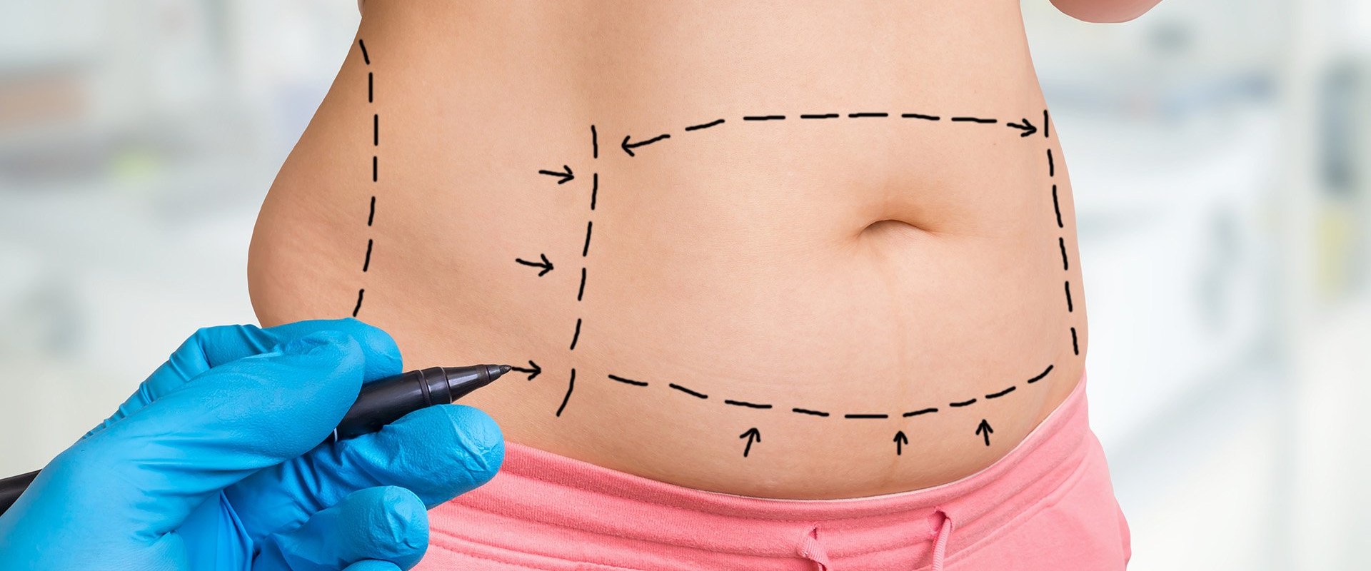 Why Liposuction Is The Top Nonsurgical Fat Reduction Option In Stafford