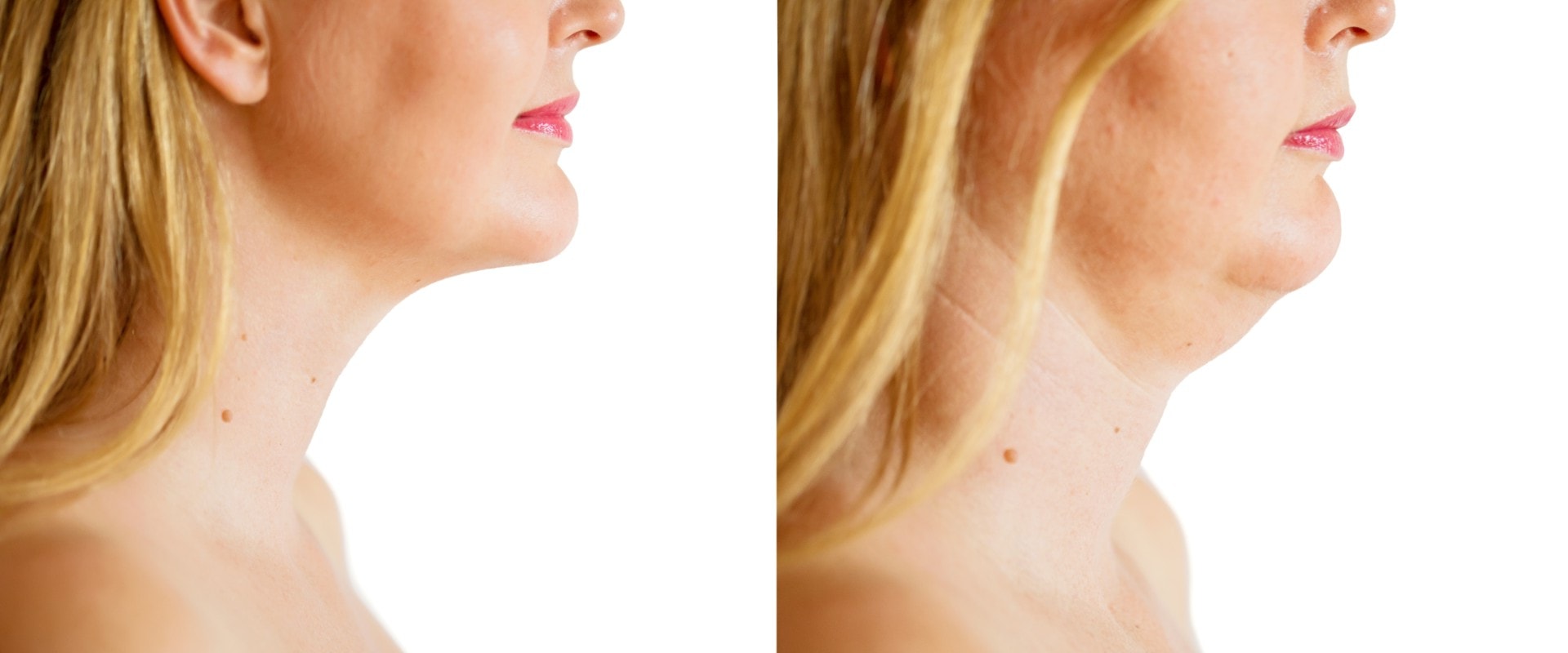 The Truth About Nonsurgical Fat Reduction And Double Chin Liposuction In NYC