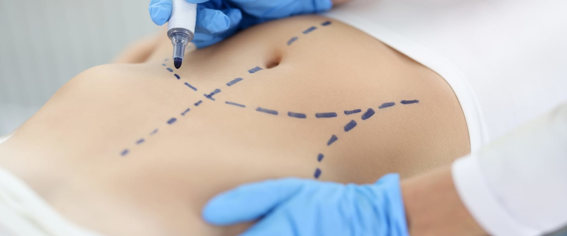 Tummy Tuck Surgery In New Jersey: The Superior Option To Nonsurgical Fat Reduction For A Sculpted Abdomen