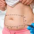 Why Liposuction Is The Top Nonsurgical Fat Reduction Option In Stafford