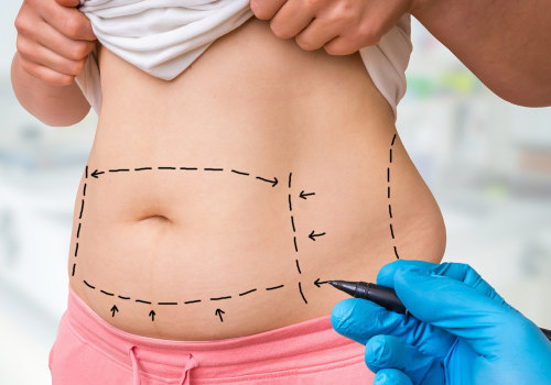 Why Liposuction Is The Top Nonsurgical Fat Reduction Option In Stafford