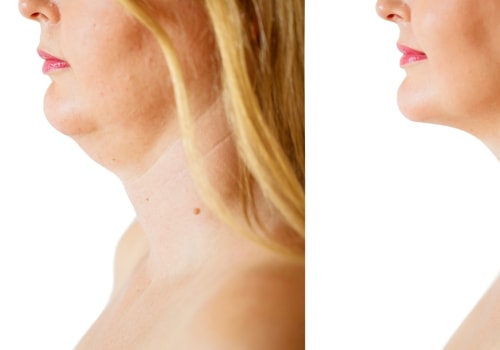 The Truth About Nonsurgical Fat Reduction And Double Chin Liposuction In NYC